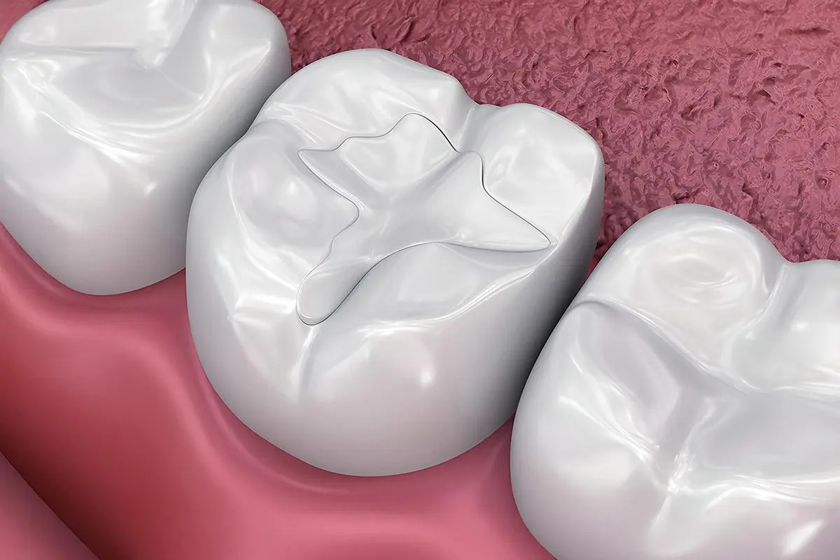Dental Fillings