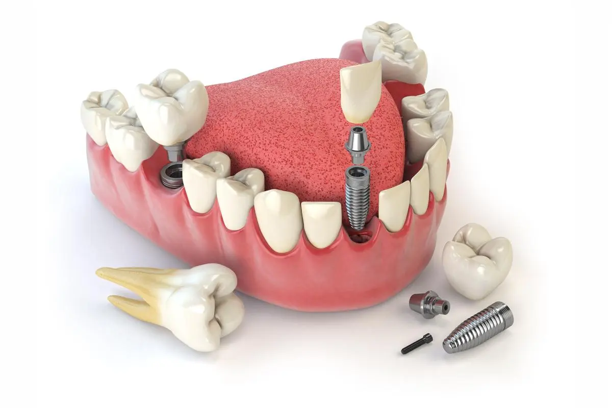 Dental Implants