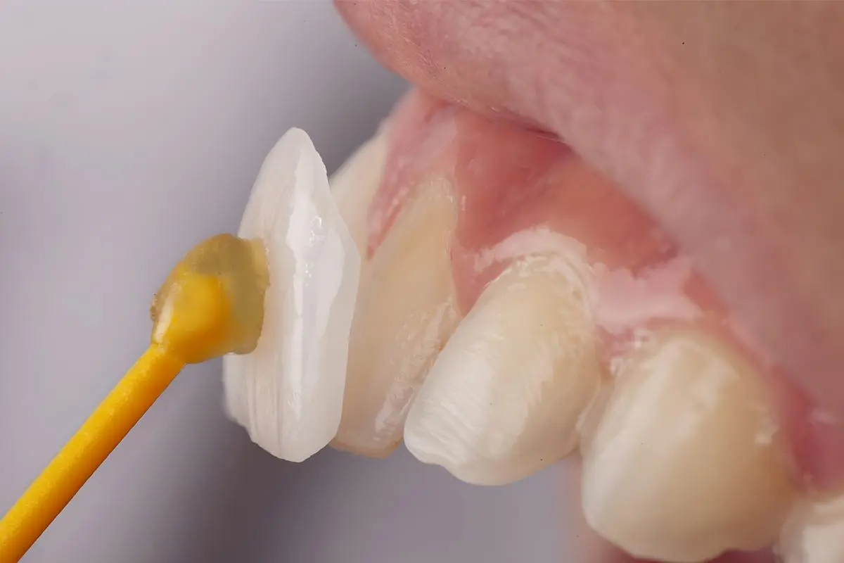 Laminate Veneers