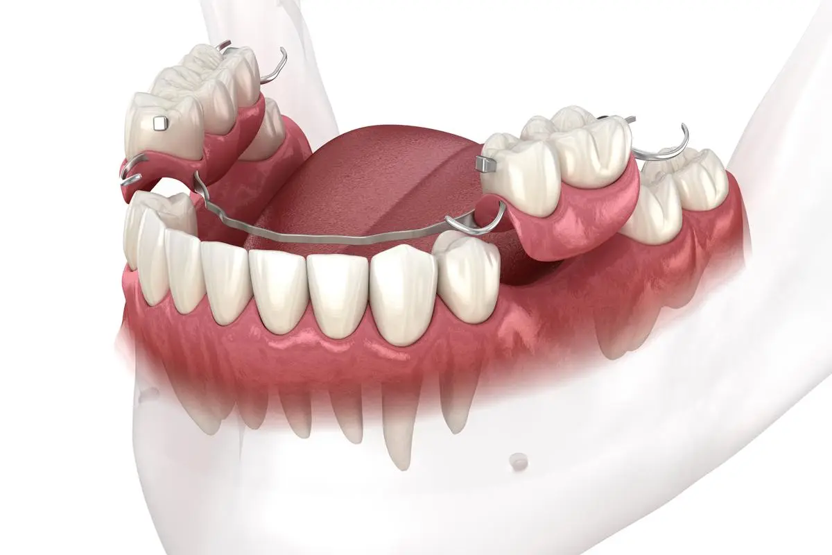 Dental Prosthetics